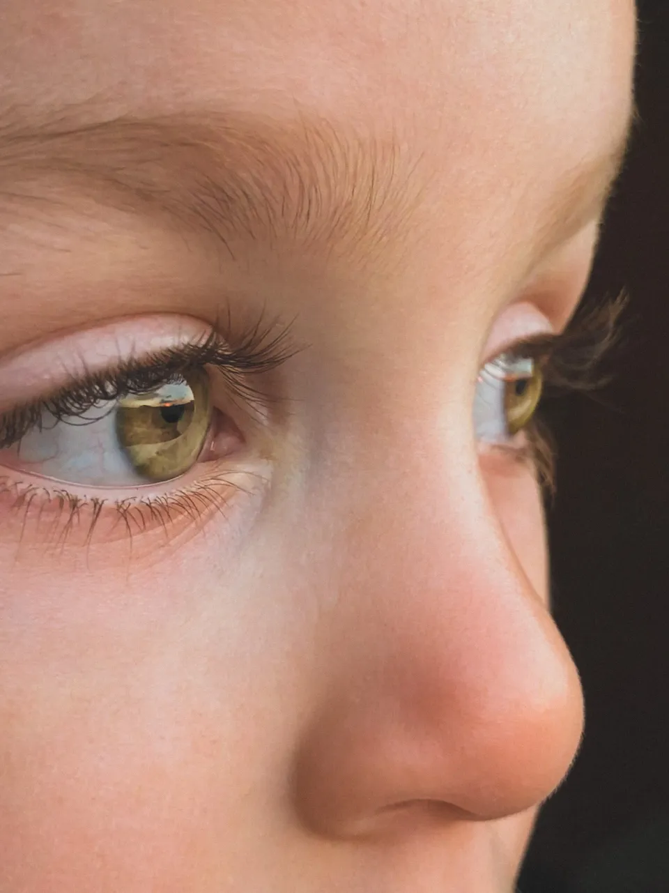 Childhood Myopia Triples by Age 12