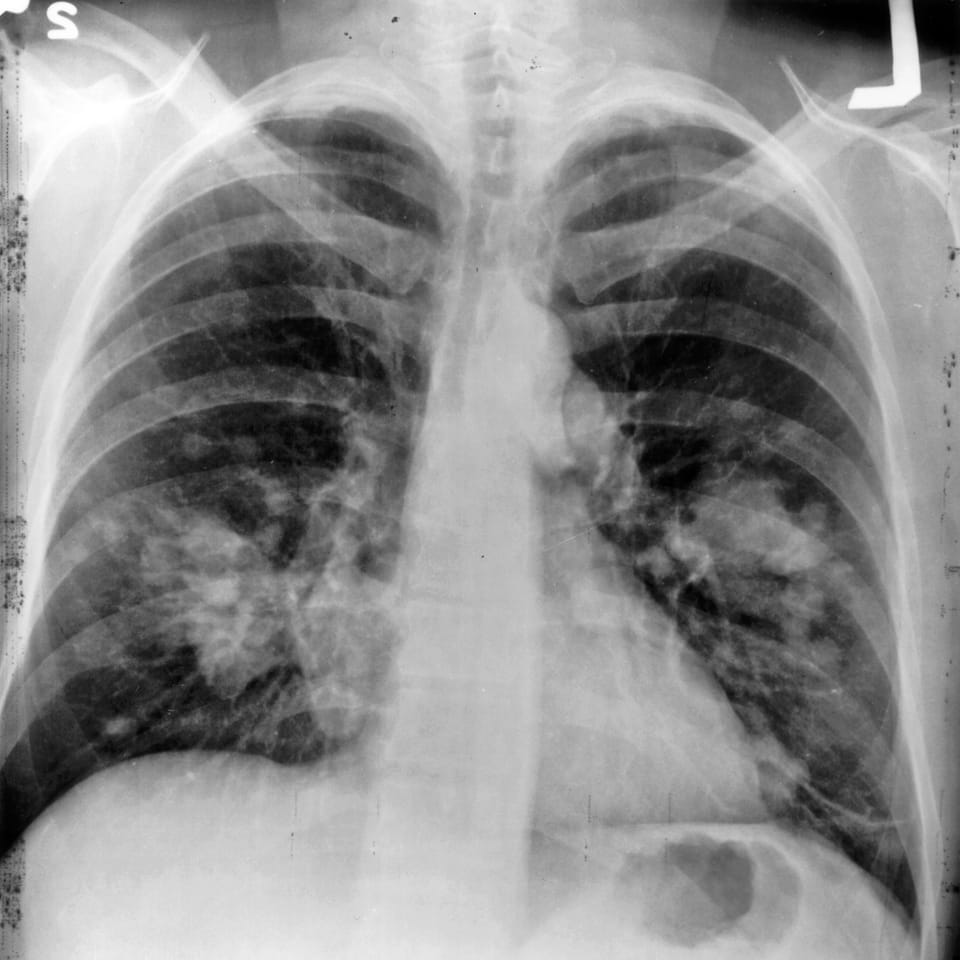 Catalonia to Launch Lung Cancer Screenings in 2027